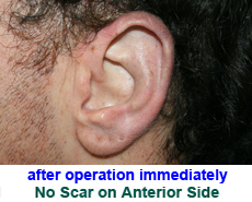 plastic-surgery-prominent-ear 